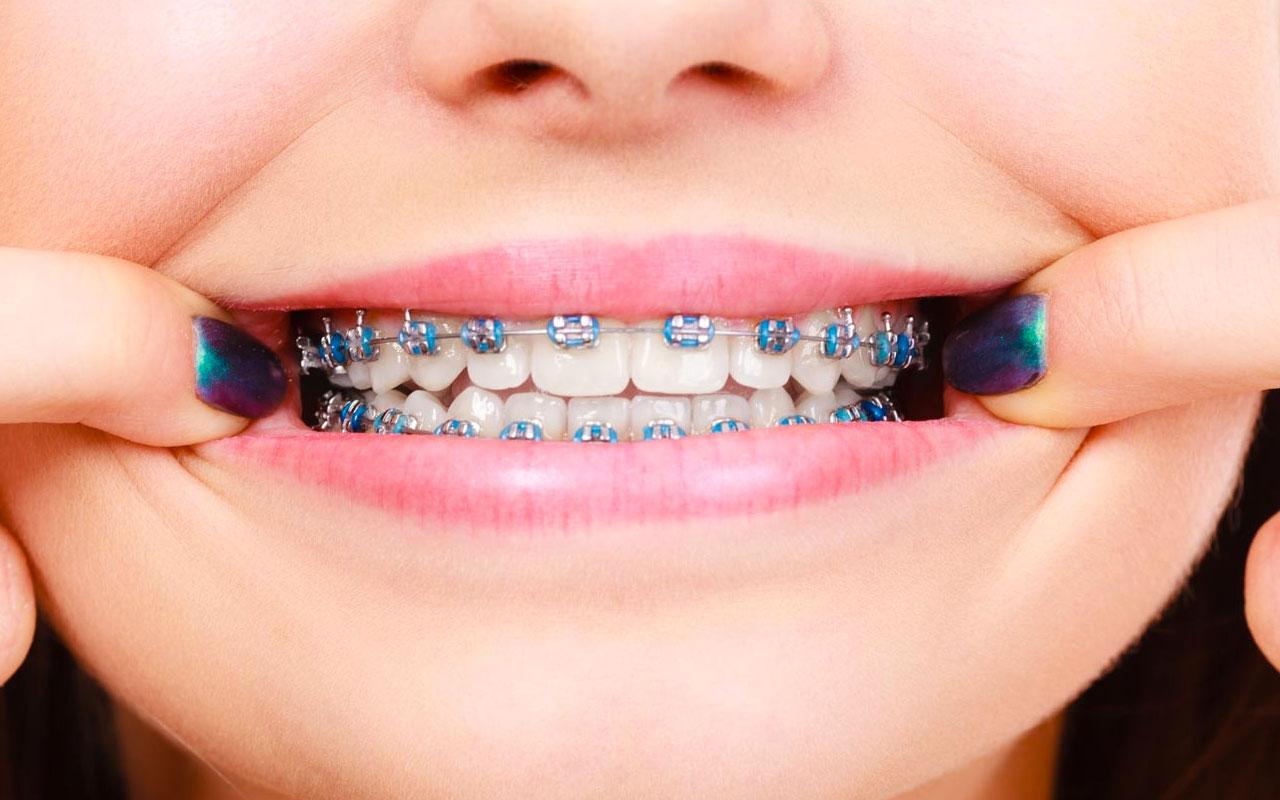 Diş Teli Nasıl Takılır Ve Çeşitleri Nelerdir?