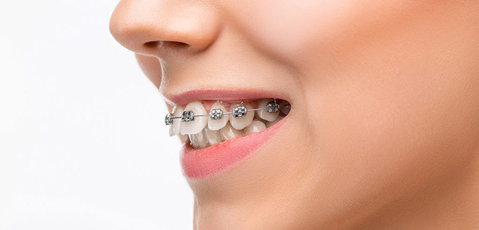 Diş Teli Tedavisi ve Diş Teli Tedavisi Aşamaları