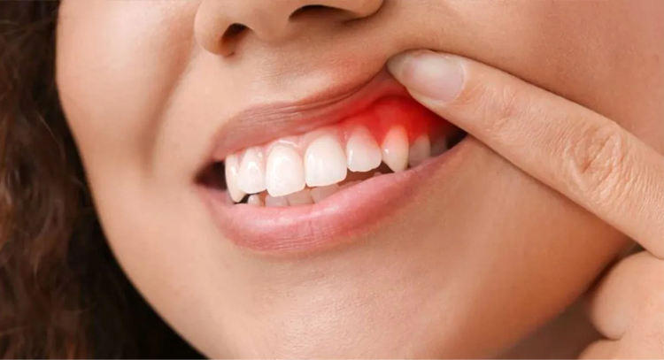 Diş Eti Sağlığının Vücudumuz İçin Önemi
